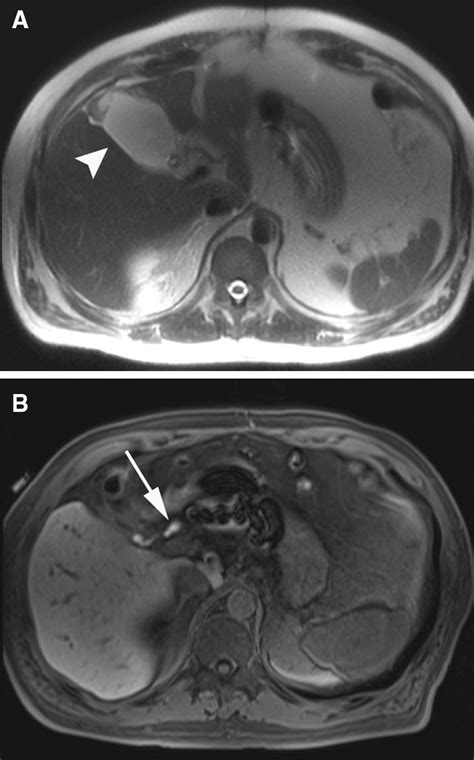 bile leakage symptoms|Cholecystectomy Intra